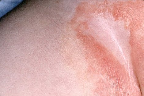 7 tipos de dermatite e quais as causas 4 Dermatite da fralda