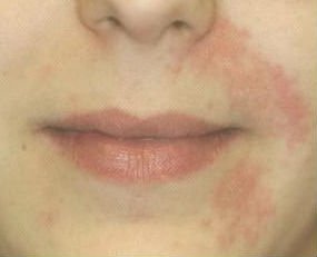 7 tipos de dermatite e quais as causas 5 Dermatite perioral