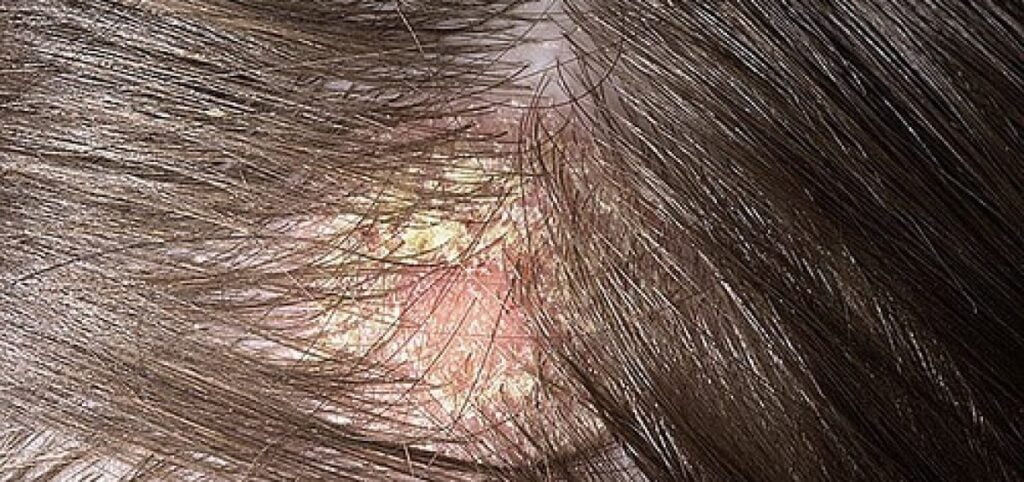 7 tipos de dermatite e quais as causas 3 Dermatite seborreica