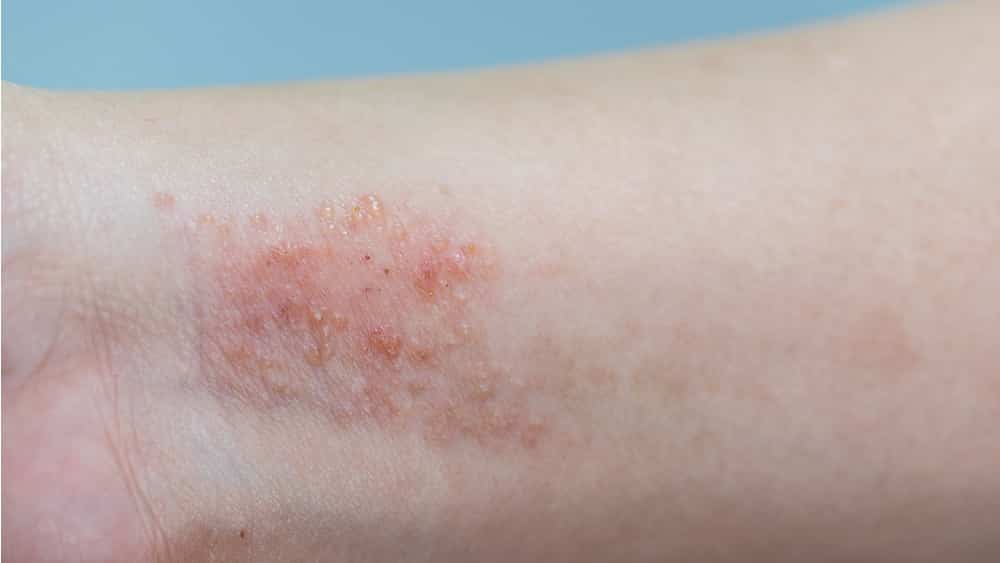 7 tipos de dermatite e quais as causas 2 dermatite atopica