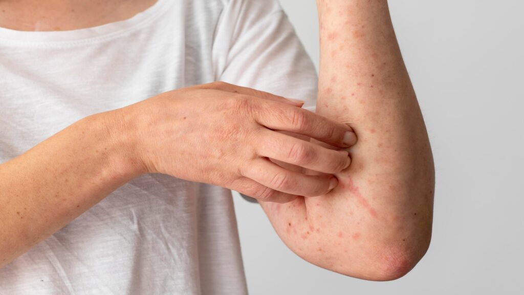 7 tipos de dermatite e quais as causas 7 mariposa hylesia