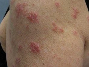 7 tipos de dermatite e quais as causas 6 nummular eczema12 ProtectWyJQcm90ZWN0Il0 FocusFillWzI5NCwyMjIsIngiLDFd 5972230