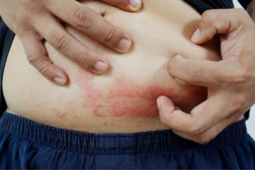tipos de dermatite