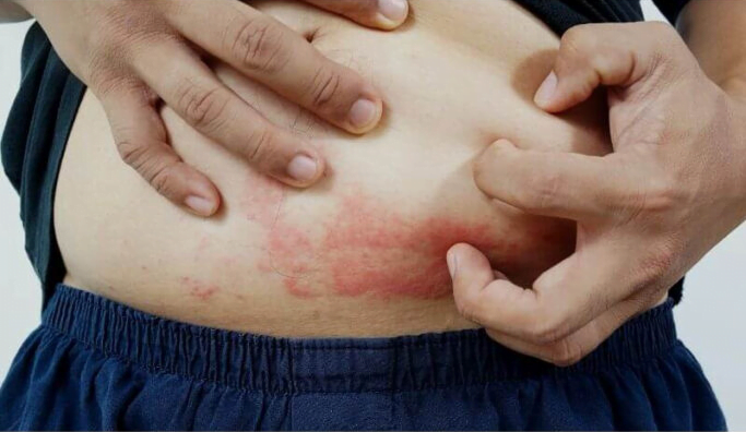 7 tipos de dermatite e quais as causas 1 tipos de dermatite