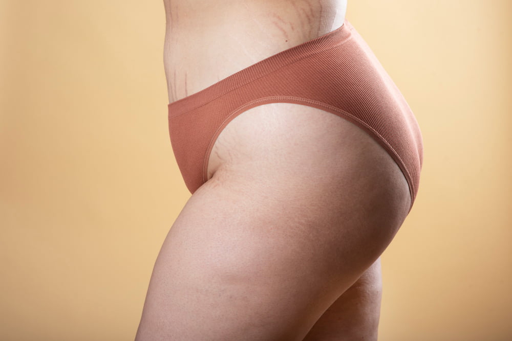 Como acabar com a retenção de líquido 2 close up woman posing underwear