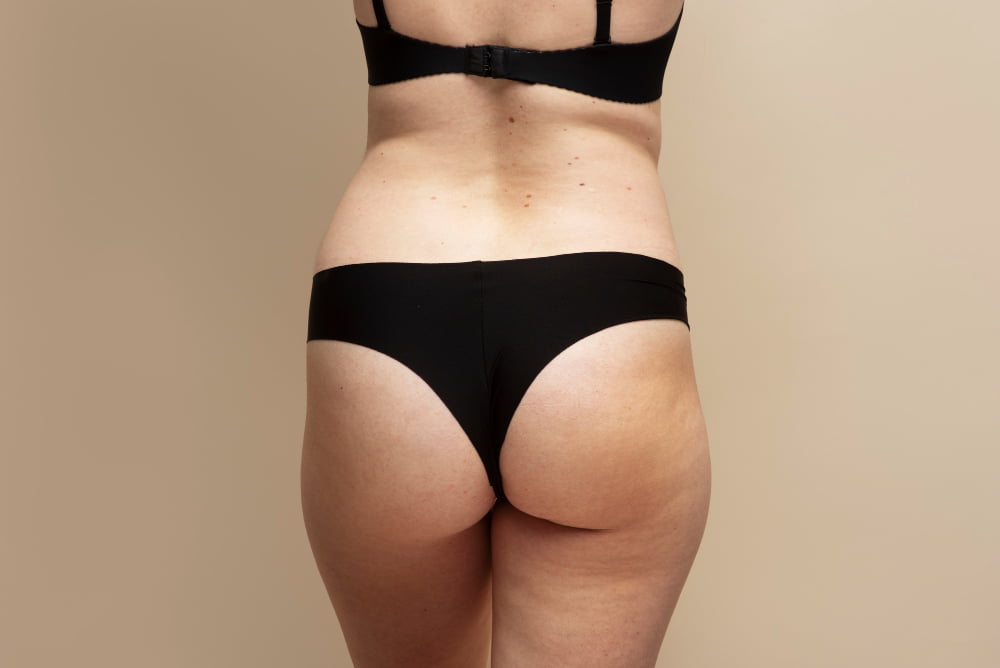 Como acabar com a retenção de líquido 4 close up woman with beautiful body back view