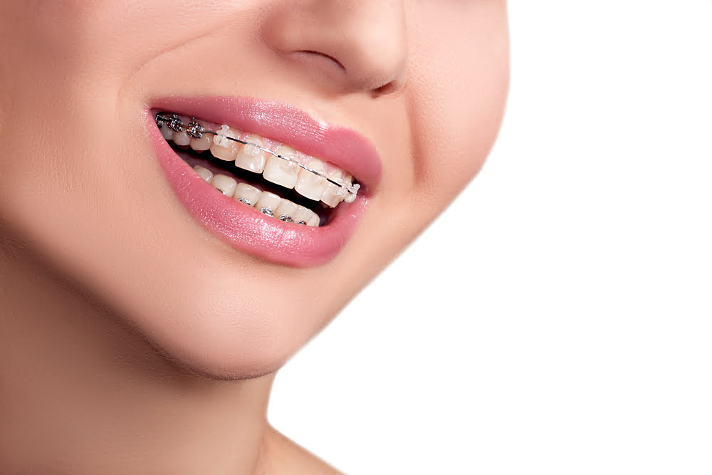 A partir de quantos anos pode usar aparelhos dentários? 3 aparelho dental